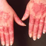 Lupus fotografie, simptomele si tratamentul bolii (bolilor) Lupus fotografie, simptomele si tratamentul bolii