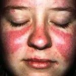 Lupus fotografie, simptomele si tratamentul bolii (cauza) Lupus fotografie, simptomele si tratamentul bolii