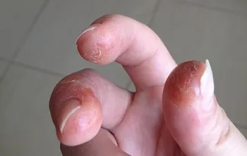Nociv în caz de unghii cu gel de unghii - efecte dăunătoare compoziției nocive pentru utilizarea sa constantă (polish gel) Nociv în cazul în gel lac de unghii - efecte adverse asupra compoziției ca fiind nocive pentru utilizarea sa constantă