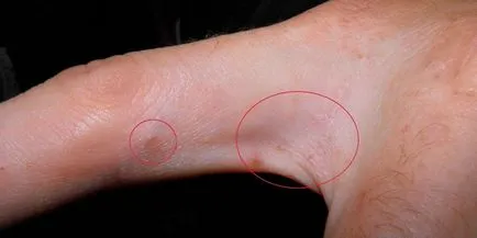 Pruritul pe mâini - cauza iritației și erupții cutanate la adulți și copii, diagnostic și (mâncărime) Pruritul pe mâini - cauza iritației și erupții cutanate la adulți și copii, diagnostic și