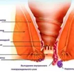 чи можна вилікувати геморой назавжди