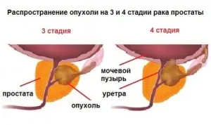 як лікувати рак простати 3 стадії