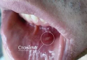 лікувати стоматит дорослих