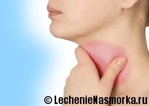 як лікувати інфекційний фарингіт