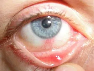 Дерматит повік: лікування, симптоми, причини апатичний дерматит лікування фото