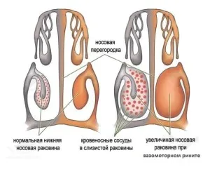 Атрофічний риніт - не вирок! як лікувати атрофічний риніт