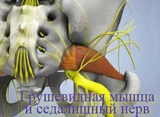 Як лікувати радикуліт ноги грушоподібна м'яз