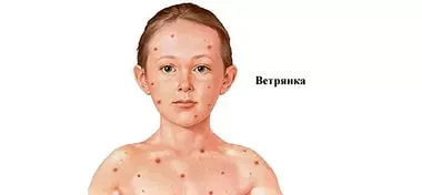 вилікувати вітрянку швидко