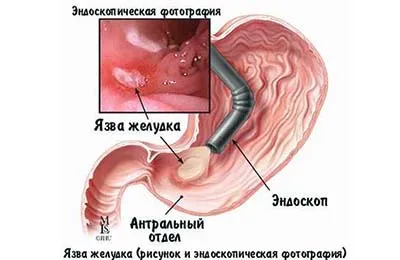 як лікувати псоріаз активованим вугіллям