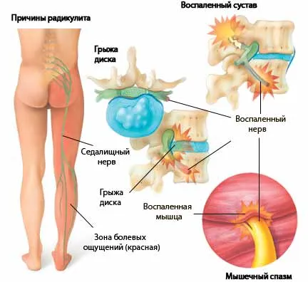 Як лікувати радикуліт ноги остеохондроз