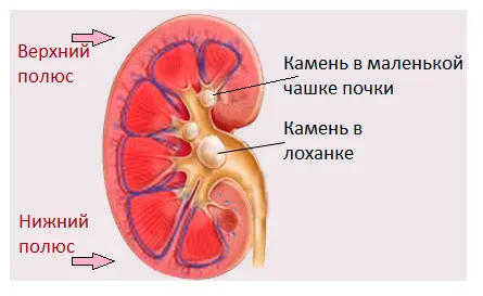 як лікувати нирки камені