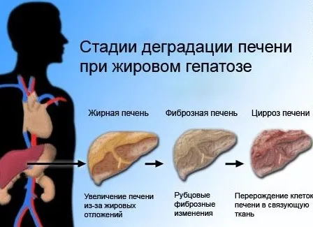 як лікувати гепатоз печінки в домашніх умовах