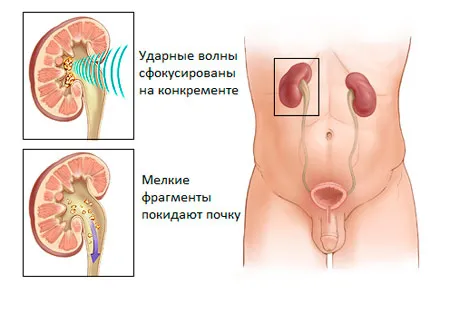 як лікувати нирки камені