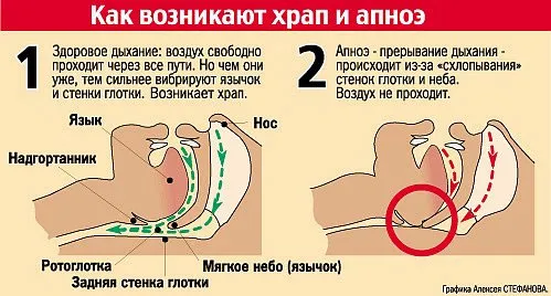 як лікувати нічну тахікардію