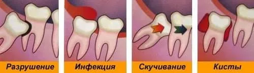 Зуб мудрості - видаляти або лікувати боляче лікувати ясна