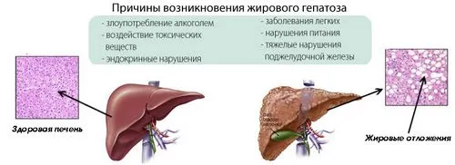 як лікувати гепатоз печінки в домашніх умовах