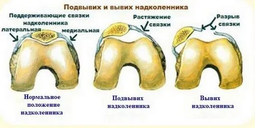 як лікувати розтягнення зв'язок коліна