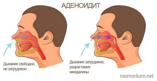 зелені соплі у дорослого