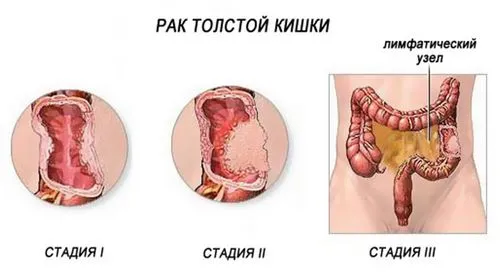 як лікувати рак кишечника