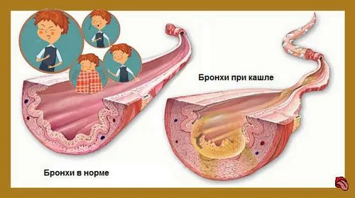 Сухий кашель і температура у дитини інфекція