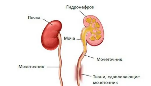 Гідронефроз нирок: причини, симптоми, діагностика гідронефроз нирок що це таке
