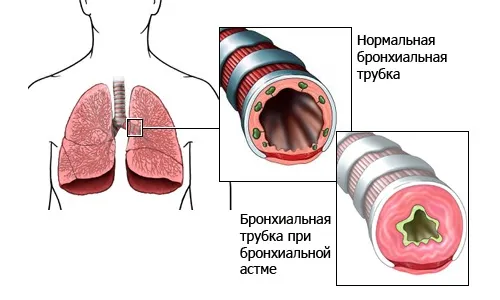 Алое при бронхіальній астмі як лікувати астму алое