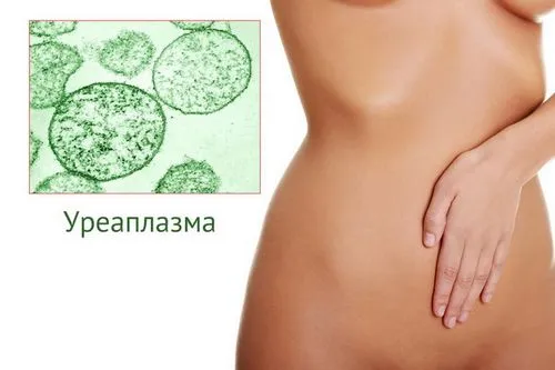як лікувати підвищену уреаплазму