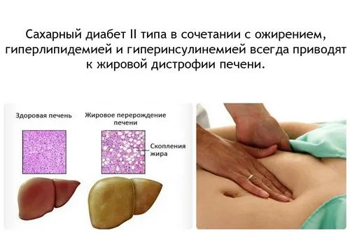 як лікувати гепатоз печінки в домашніх умовах