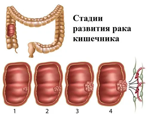 як лікувати рак кишечника