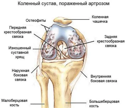 як лікувати суглоби в колінах в домашніх умовах