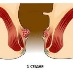 чи можна вилікувати геморой назавжди