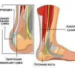 як лікувати бурсит ахіллового сухожилля