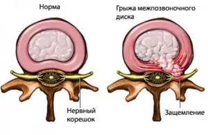 шийний радикуліт лікування в домашніх умовах