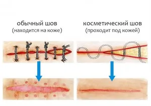 як лікувати підшкірні жировики на обличчі