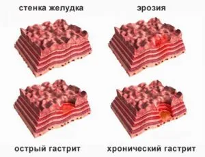 лікувати гастрит дієтою