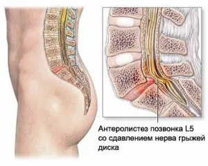 Остеохондроз 2 ступеня поперекового відділу: лікування і симптоми як лікувати остеохондроз другого ступеня