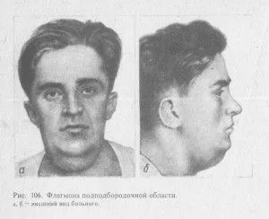 як лікувати лімфовузли під щелепою