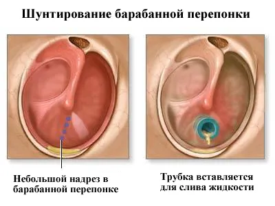 як лікувати гнійний отит у дітей