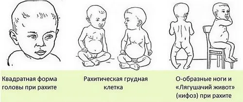 Ознаки рахіту у немовлят як лікувати рахіт у дитини 8 місяців
