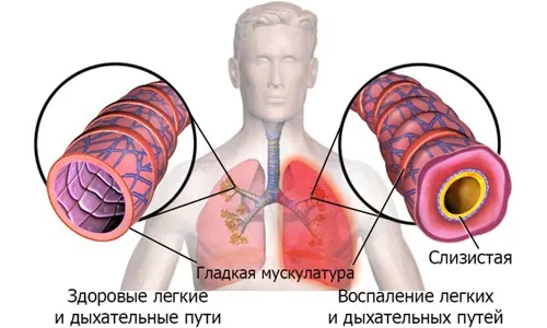 як лікувати хронічну пневмонію