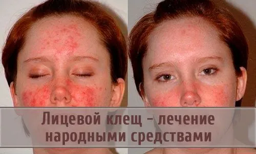 як лікувати підшкірний кліщ демодекс