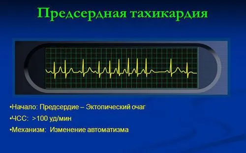 як лікувати предсердную тахікардію