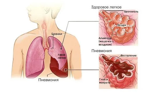 як лікувати бронхіальну пневмонію