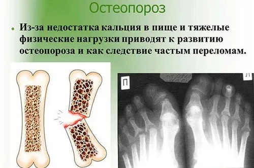 Остеопороз стопи: симптоми і лікування як лікувати остеопороз стопи