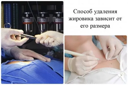 як лікувати підшкірні жировики на обличчі