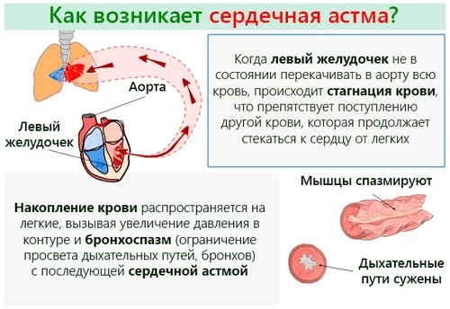 як лікувати астму серця