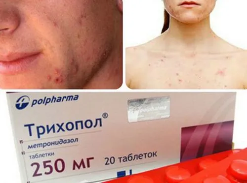 як лікувати демодекоз трихополом
