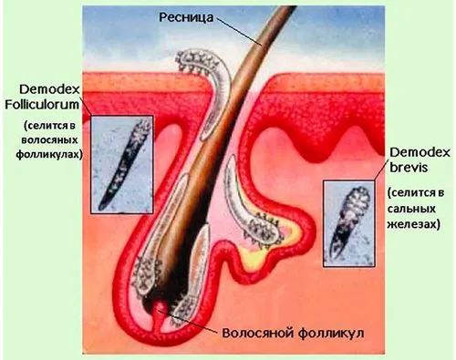 як лікувати підшкірний кліщ демодекс