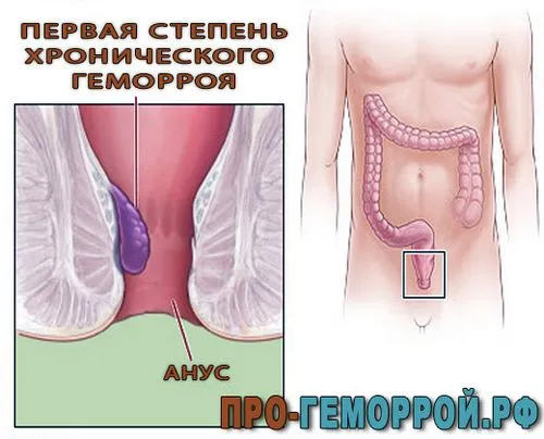 Хронічний геморой 1 ступеня: симптоми і лікування першого ступеня хронічний геморой 1 ступеня