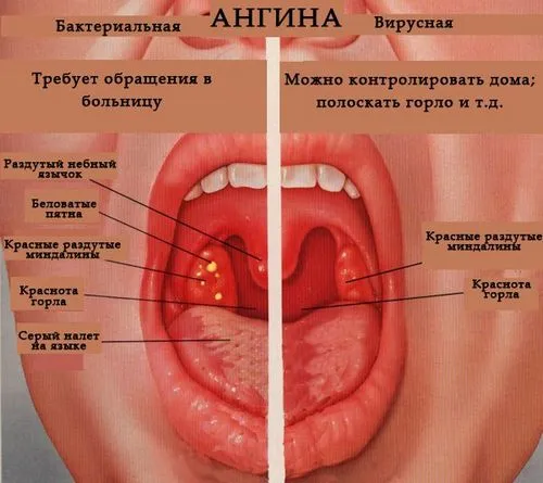 як лікувати тонзиліт дитині 3 роки